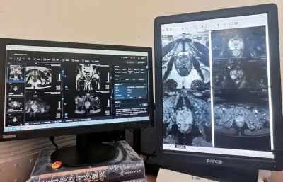 聚焦前列腺癌早筛早诊！仁济医院“医生+ AI”协作阅片，助力影像精准诊断