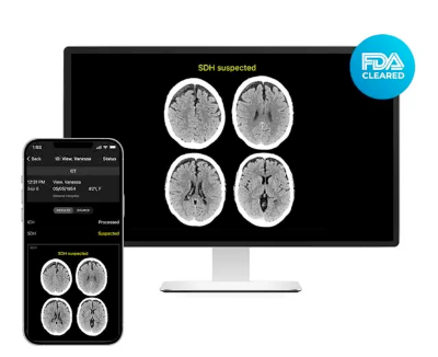 FDA批准一款AI医疗影像，一分钟识别脑出血